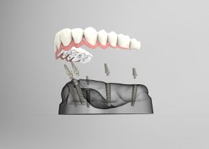 dental implants Burnaby on How All on 4 dental implants work