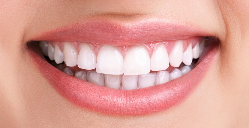 Teeth-Whitening-after