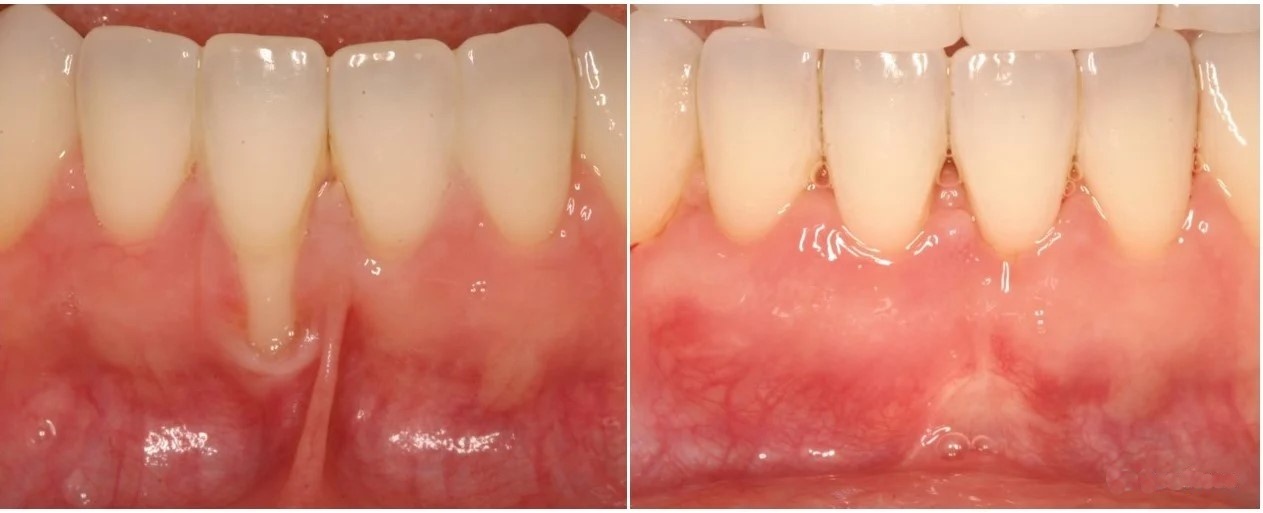 gum recession before & after